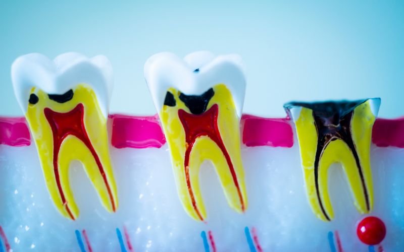 Abbildungen von Zähnen, die eine Zahnfüllung benötigen<br />
