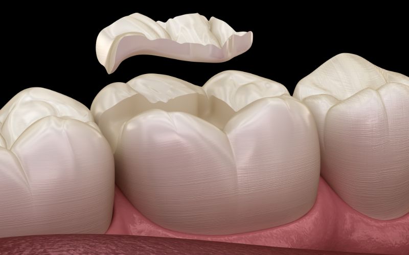 Abbildung von Kunststoff Zahnfüllung