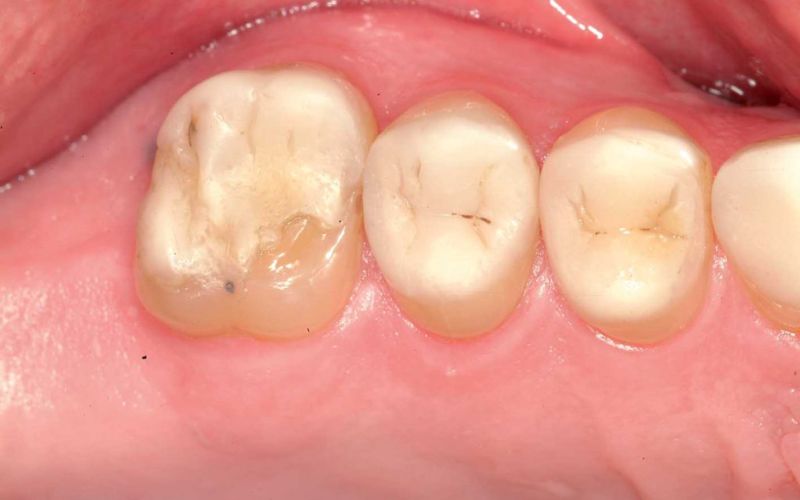 Abbildung einer Komposit Zahnfüllung